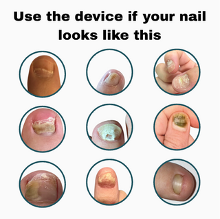 NuvoCare - Blue Light Nail Fungus Treatment at Home